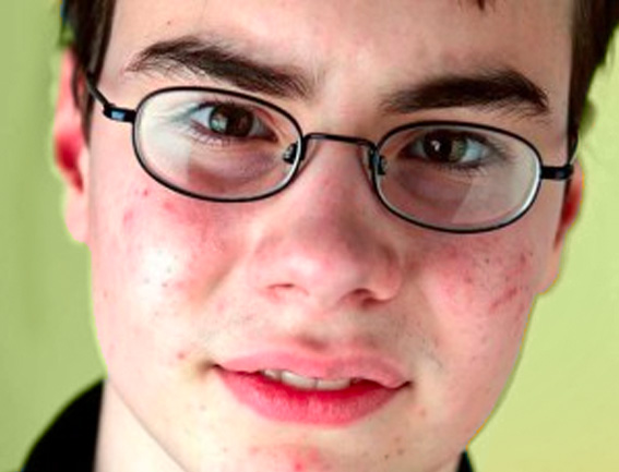 blog-accutane