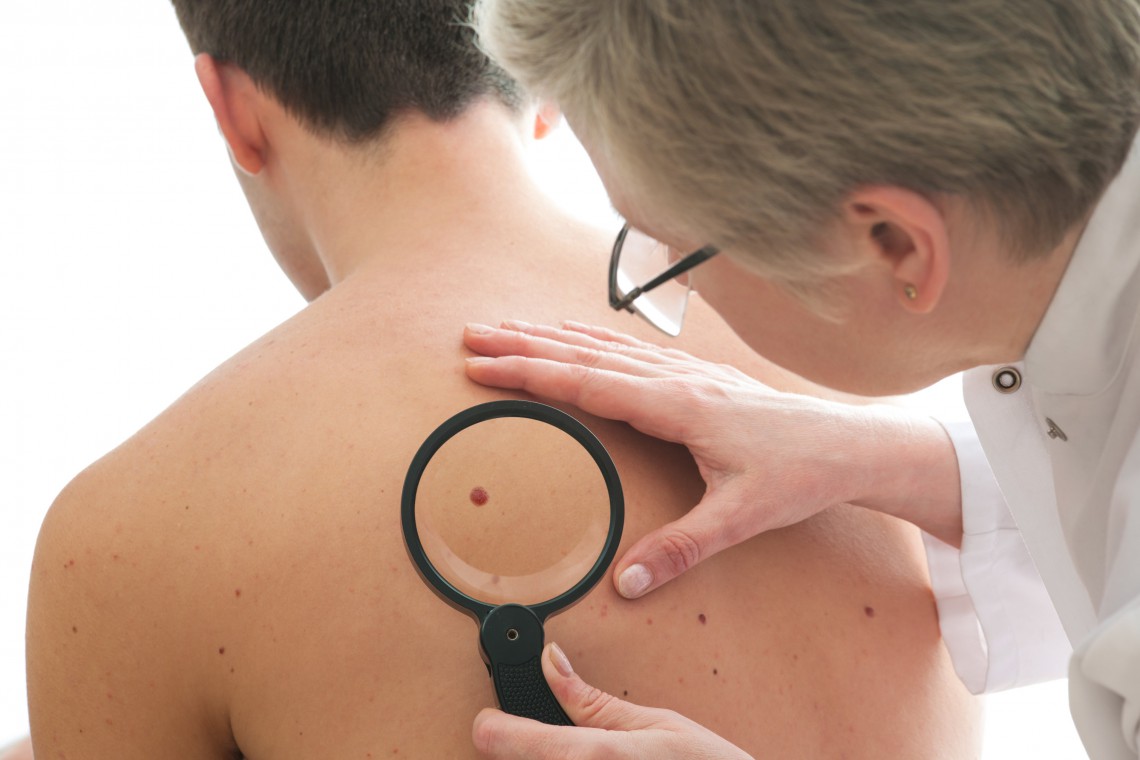 Dermatologist examines a mole